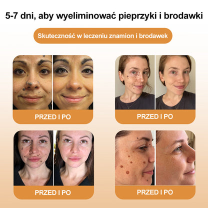 💝[✨Oficjalny sklep markowy✨] FROPUN™ Jad pszczeliKrem do leczenia kretów i brodawek (👨‍⚕️PTD AJÁNLJA)